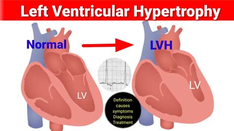 lv medical abbreviation cardiology|lvh and stroke.